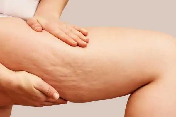 Image of woman showing leg with cellulite Cribbs Causeway