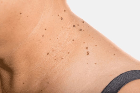 Are you looking for easy skin tag removal Cribbs Causeway - then contact Spire today!