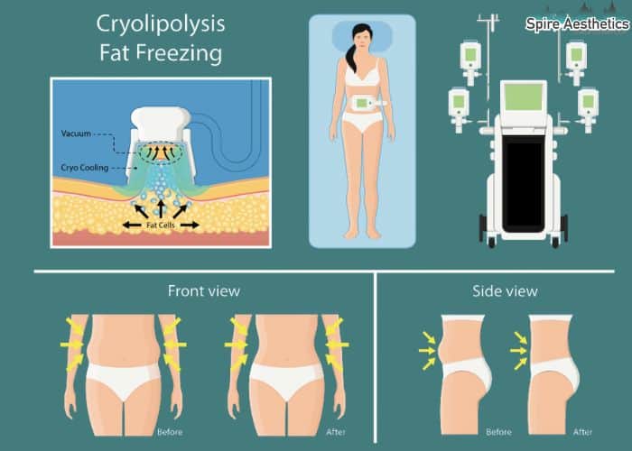 Image of diet and fat freezing combined for best results for Spire Aesthetics Cribbs Causeway